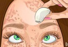 Skin spots: Remove them in just a few minutes in a completely natural and healthy way — it’s truly amazing!