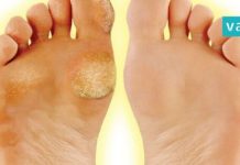 Get rid of corns and calluses quickly and painlessly!