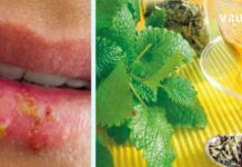 By knowing these simple tips, you won’t have to worry about your appearance when a herpes infection flares up. In this article, you will learn how to treat herpes at home.