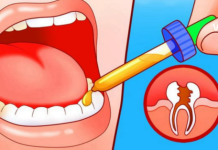 An infusion of marsh cinquefoil rhizomes (prepared with either water or alcohol) is effective for rinsing the mouth in cases of toothache, gum diseases, and unpleasant oral odor (bad breath).