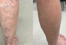 Prepare willow baths and forget about varicose veins, rheumatism, and arthritis forever.