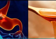 Treatment of Gastritis with Honey